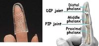 Open Air Stax Finger Splint #5.5
