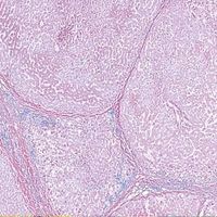 Human Cirrhosis of Liver, sec. 7 m H&E Microscope Slide