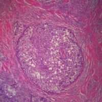 Human Adenocarcinoma of Breast, sec. 7 m H&E Microscope Slide