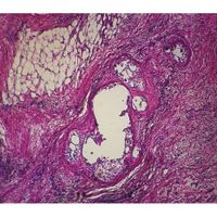 Human Adenocarcinoma of Lung, sec. 7 m H&E Microscope Slide