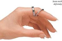 Murphy Ring Splint, Stainless Steel #2