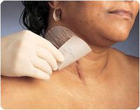 Semmon preston Mepiform Self-Adherent Silicone Dressing