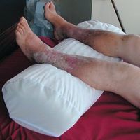 DSS Conforming Comfort Venous Status Positioning Device (Moisture-Proof Cover)