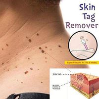 Skin Tag Remover Skin Tag Mole Genital Wart Remove, Foot Treatment Mole Skin Tag Body Warts Remover, Skin Tag Removal Medical Tu Kill Remover, Not Cause Pain, Effective, Fast, No Side Effects 1PC