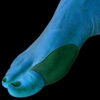 MCK13163000 - Pedifix Bunion Protector Visco-Gel Hallux Bunion Guard One Size Fits Most Without Fastening Left or Right Foot