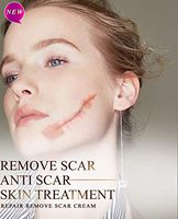 Remove Scar Anti Scar Skin Treatment Repair Remove Scar Cream, Removal Scar Stretch Marks