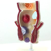 Medical Science Rectum Fissure Lesion Model 1.5X Human Anorectal Pathology Model Hemorrhoid Anal Fistula