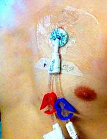 PICC Moisure Barrier for Shower - Transparent Film Wound Dressing Protection Cover, 4 x 4 Inch (7 Pcs)