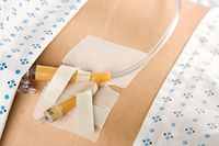 M.C. Johnson Cath-Secure Dual Tab