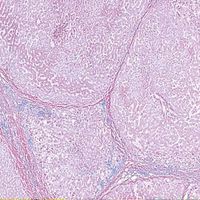 Human Cirrhosis of Liver, sec. 7 m H&E Microscope Slide
