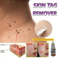 Dolnfin Strength Skin Tag Remover Foot Treatment Mole Skin Tag Body Warts Remover Athletes Foot Remedies