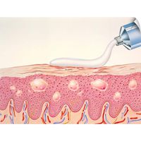 CANVAS ON DEMAND Artwork of Topical Cream Applied to Eczema Wall Decal, 40"x30"