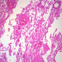 Human Tuberculosis, sec. 7 m H&E Microscope Slide